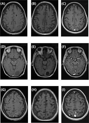 Abemaciclib plus fulvestrant for the treatment of hormone receptor-positive/human epidermal growth factor receptor 2-negative breast cancer with cystic brain metastases: A case report and literature review
